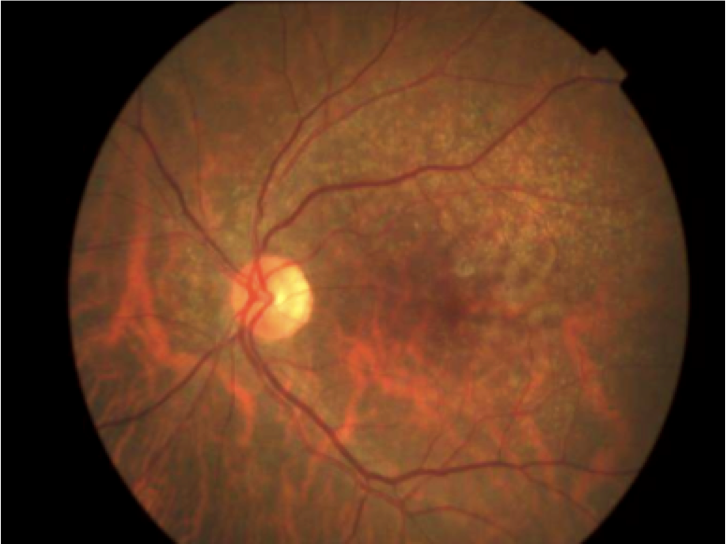 Exame de imagem para constatação da DMRI. Nesta imagem é possível constatar a DMRI Seca ou atrófica Exame de imagem para constatação da DMRI. Nesta imagem é possível constatar a DMRI Seca ou atrófica